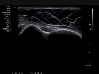 High frequency imaging of biceps tendon, датчик VF16-5
