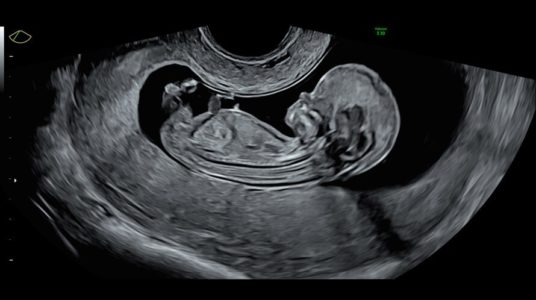 13 week fetal profile