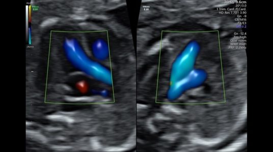 3VV and LVOT with Radiantflow™ in Dual Display