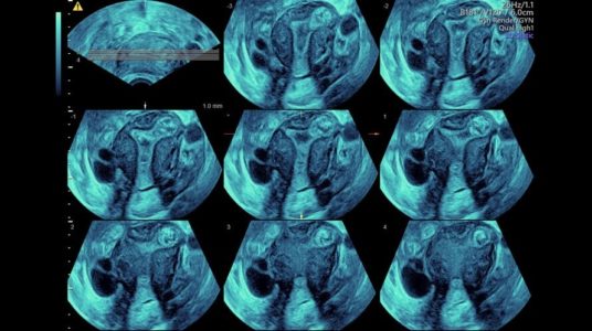 Tomographic ultrasound imaging (TUI) of uterine cavity