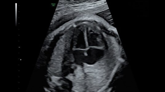 4-ех камерный срез сердца плода, 29 недель