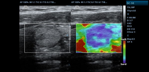 Mindray Natural Touch Elastography